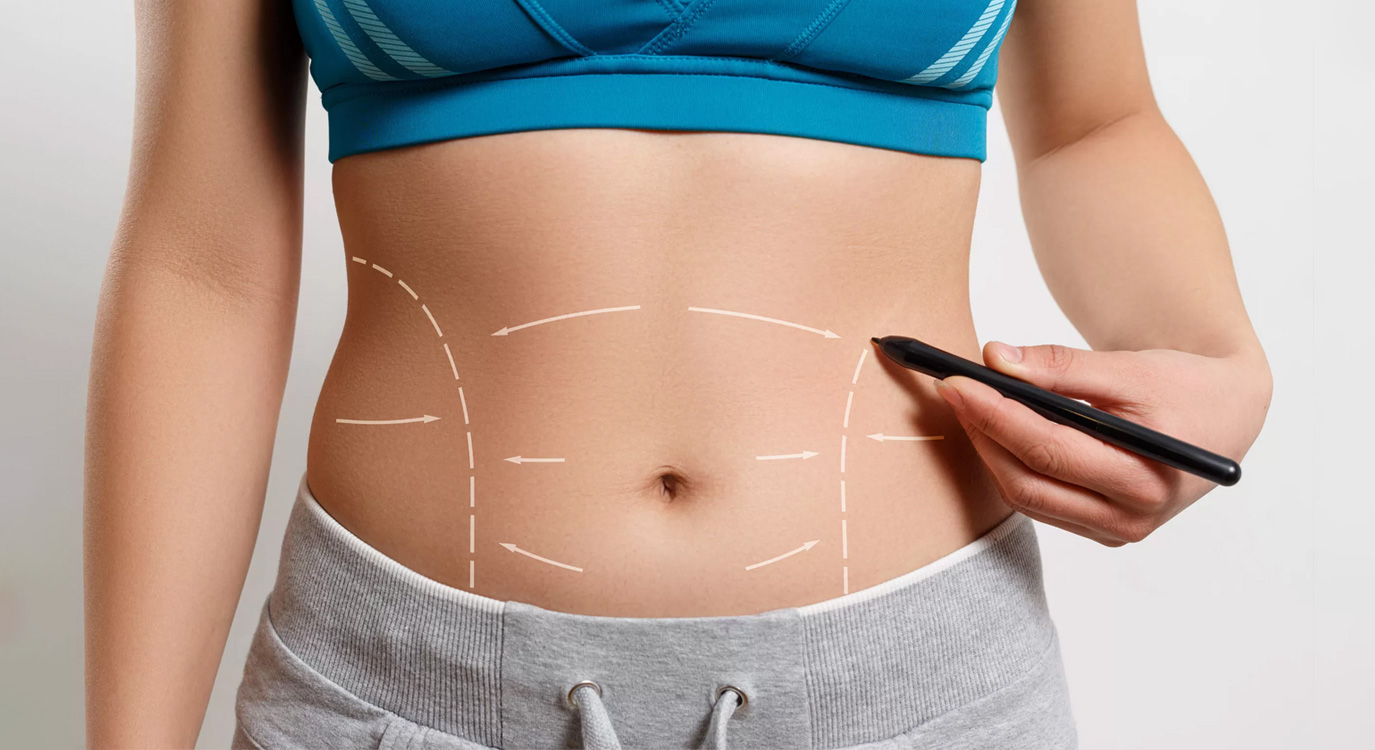 Abdominoplastia Reversa