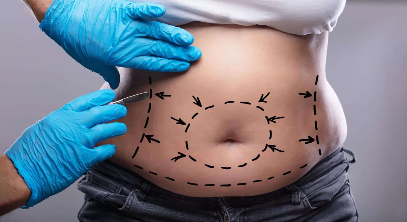 Abdominoplastia Circunferencial