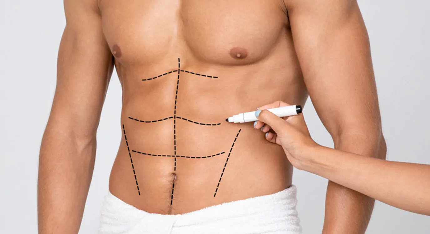 Abdominoplastia Convencional