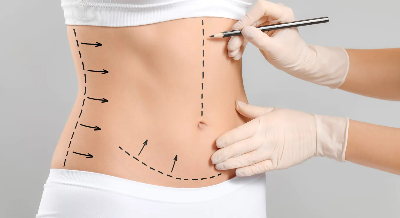 Abdominoplastia em Âncora