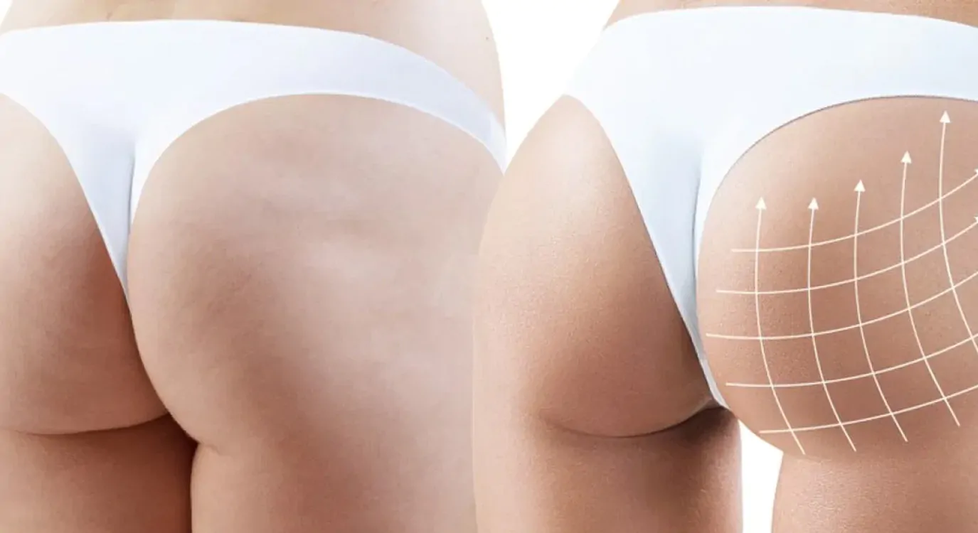 Aumento Glúteo com Implante de Silicone