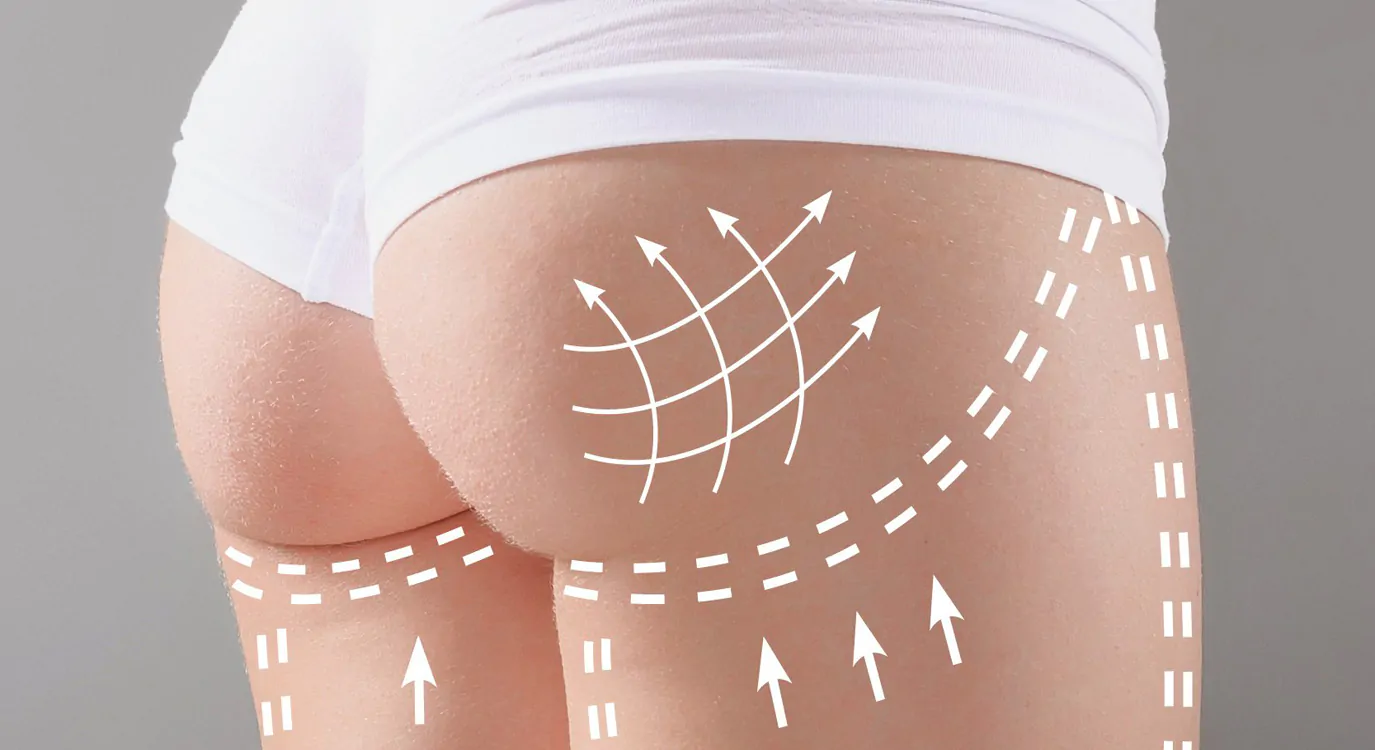 Lifting de Glúteos, também conhecido como Gluteoplastia com lifting